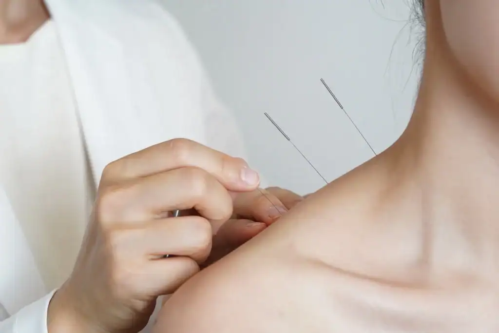 Client receiving acupuncture